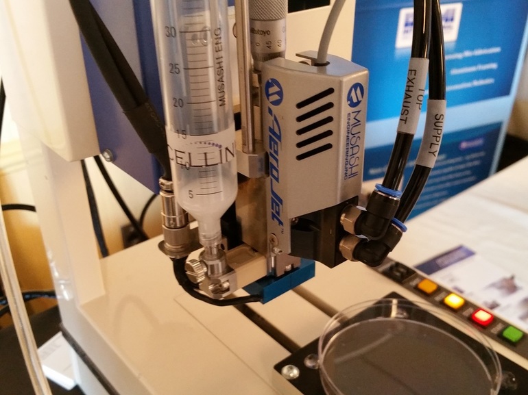 Напечатанные на 3d-принтере титановые позвонки имплантировали пациентке вместо поражённых опухолью участков позвоночника 