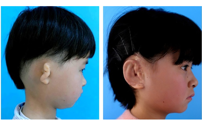 Уши для детей с недоразвитием ушной раковины
