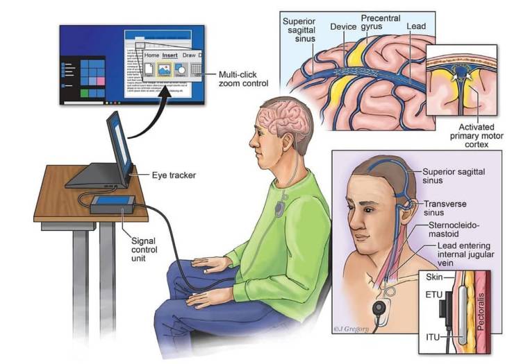 Brain in computer
